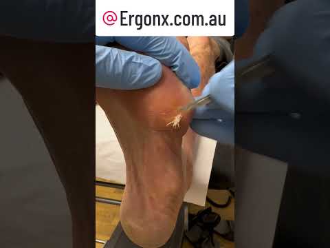 Ultimate Callus Cutting Satisfaction Podiatrist Edition #FootCare #Satisfying