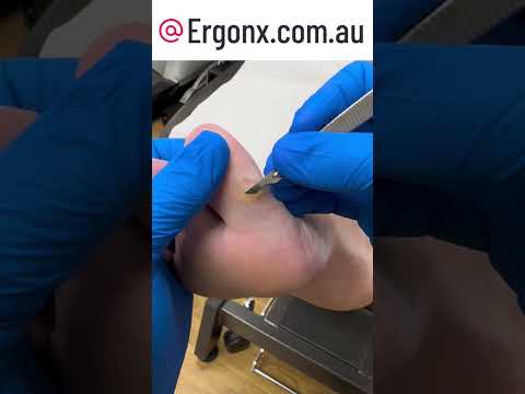 Podiatrist Removes Big Toe Corn & Callus Satisfying Treatment #Podiatry #FootCare
