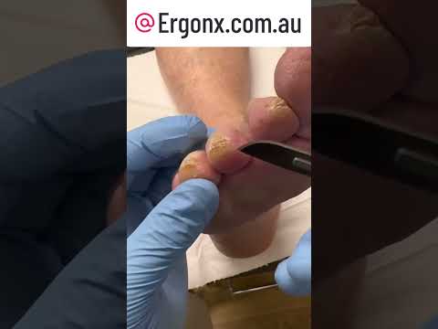 Satisfying Callus Removal in Podiatry Clinic Must-Watch #FootCare #Podiatry #SatisfyingVideos