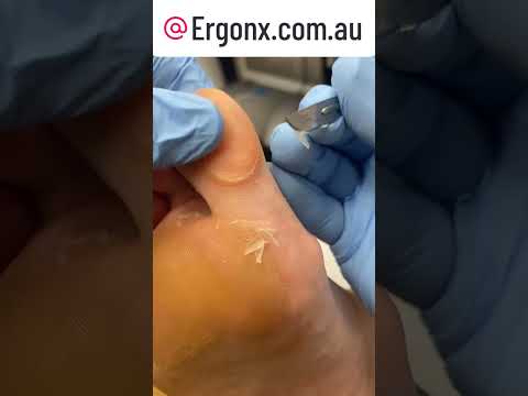 Satisfying Callus Removal at the Podiatry Clinic Big Toe Transformation #Podiatry #CallusCare