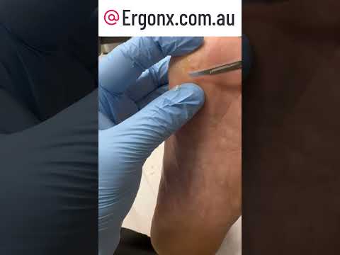 Satisfying Corn Removal by Podiatrist: Watch the Relief #CornRemoval #FootCare