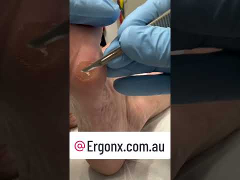 Podiatrist Removes Painful Foot Corn How To #FootHealth #Podiatry