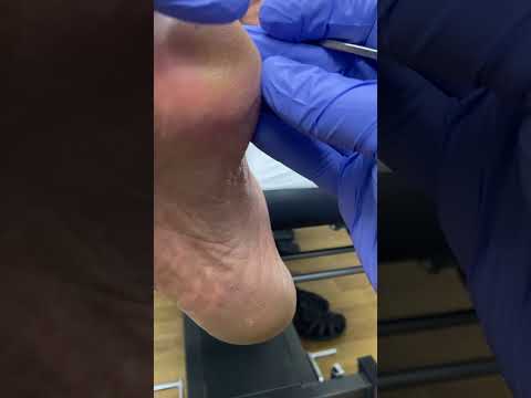 Say Goodbye to Foot Pain: Effective Corn & Callus Removal Tips #FootCare #HealthyFeet