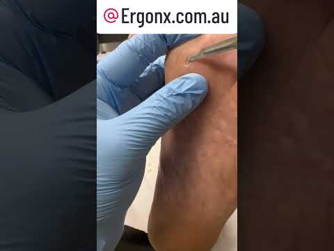 Satisfying Corn Removal with Scalpel Instant Relief Podiatrist #FootHealth #OddlySatisfying