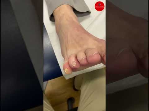 How Podiatrists Treat a Corn on the Little Toe