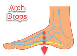 Plantar fasciitis is oftent the result from a foot that is not supported and has a flexible flat foot